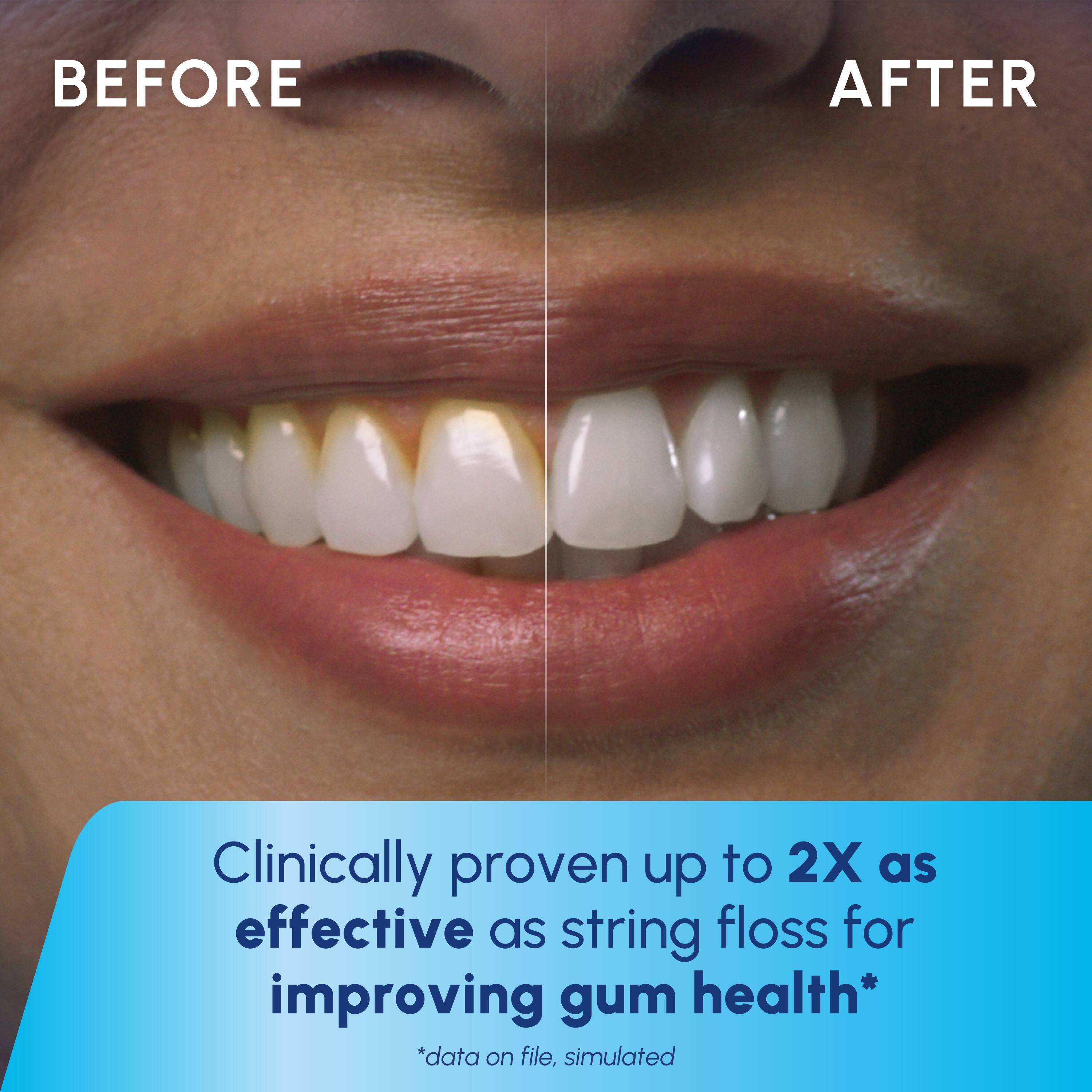 BEFORE AFTER Clinically proven up to 2X as effective as string floss for improving gum health* *data on file. simulated
