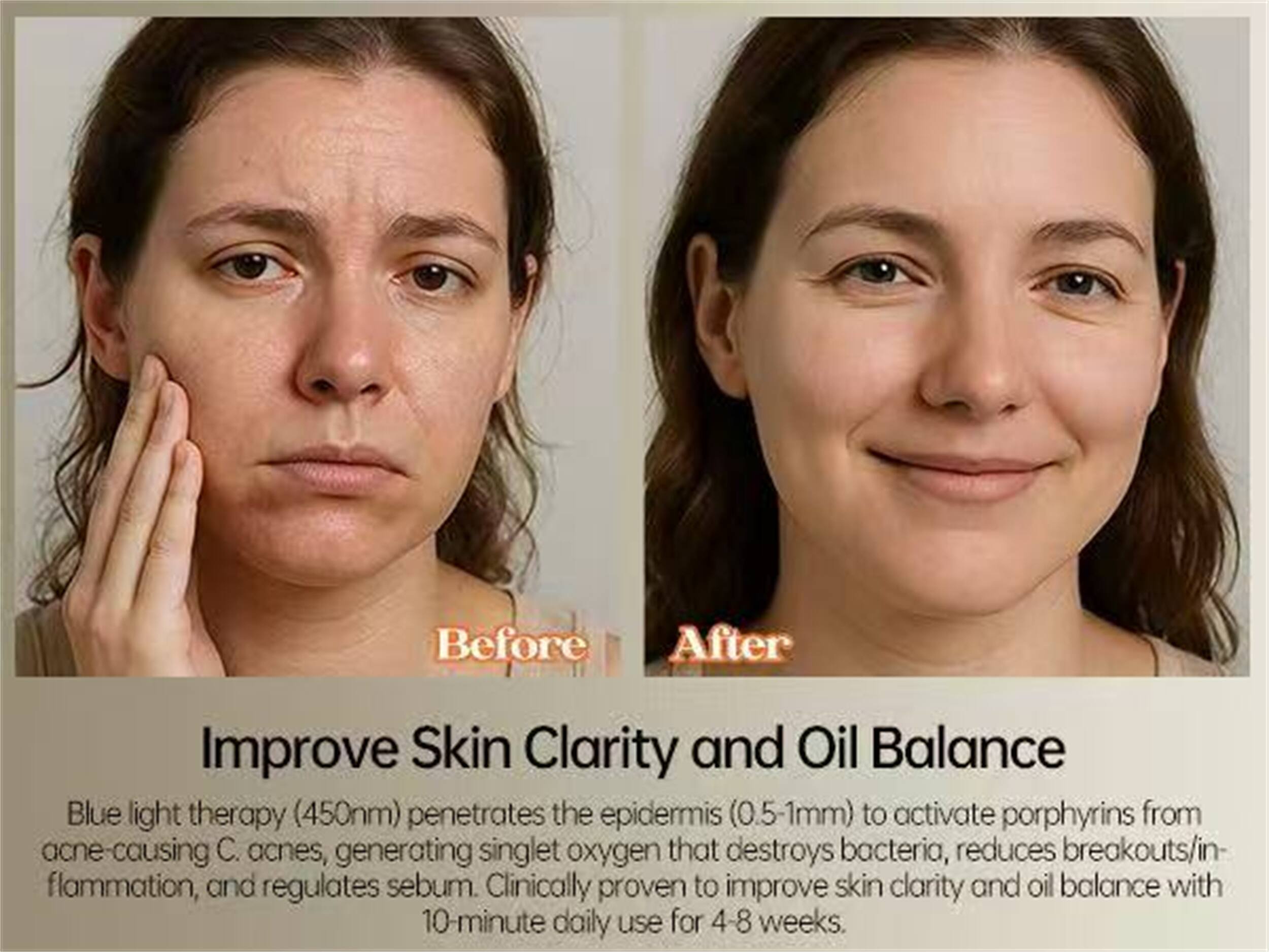 Before After

Improve Skin Clarity and Oil Balance

Blue light therapy (450nm) penetrates the epidermis (0.5-1mm) to activate porphyrins from acne-causing C. acnes, generating singlet oxygen that destroys bacteria, reduces breakouts/inflammation, and regulates sebum. Clinically proven to improve skin clarity and oil balance with 10-minute daily use for 4-8 weeks.