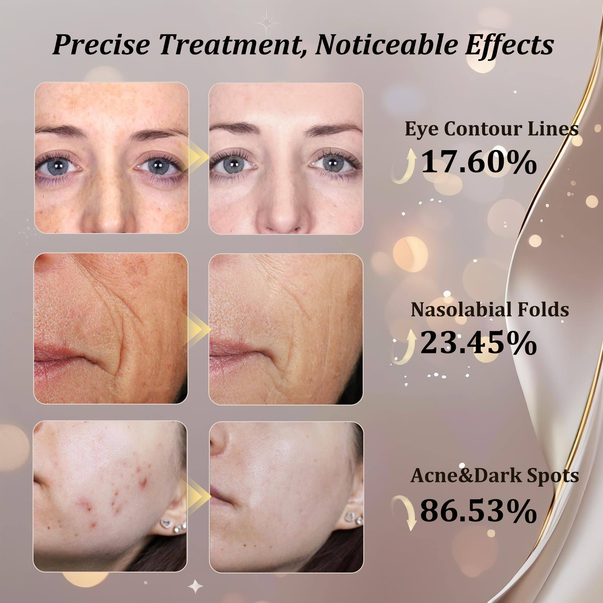 Precise Treatment, Noticeable Effects

Eye Contour Lines 17.60%

Nasolabial Folds 23.45%

Acne & Dark Spots 86.53%
