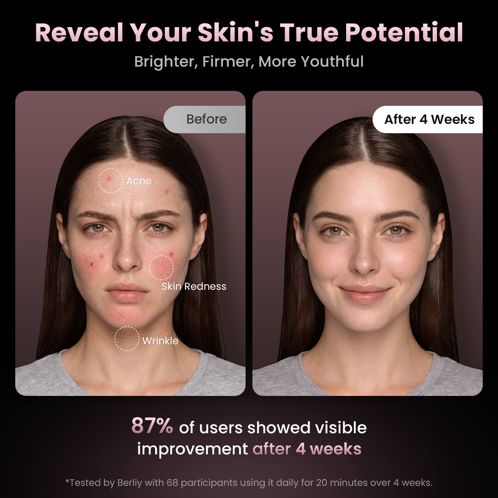 Reveal Your Skin's True Potential  
Brighter, Firmer, More Youthful  

Before  
After 4 Weeks  

Acne  
Skin Redness  
Wrinkle  

87% of users showed visible improvement after 4 weeks  
*Tested by Berliy with 68 participants using it daily for 20 minutes over 4 weeks.