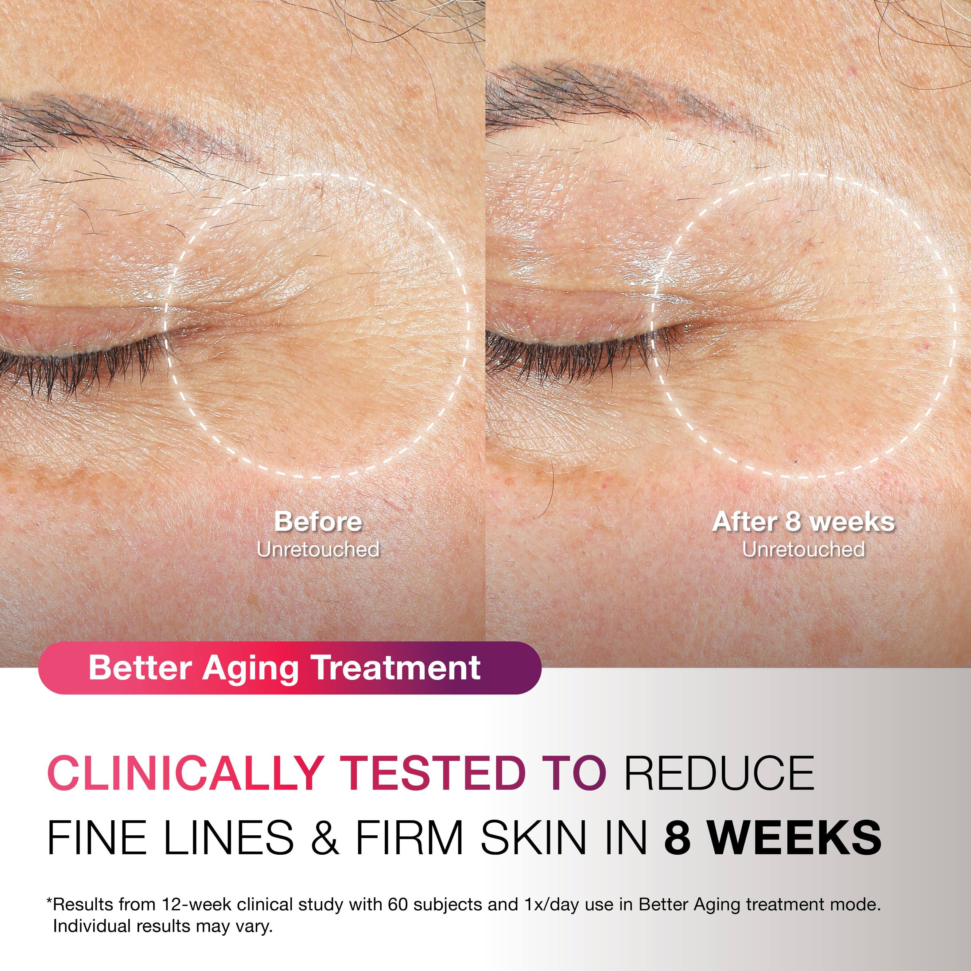 Before Unretouched  
After 8 weeks Unretouched  

Better Aging Treatment  

CLINICALLY TESTED TO REDUCE FINE LINES & FIRM SKIN IN 8 WEEKS  

*Results from 12-week clinical study with 60 subjects and 1x/day use in Better Aging treatment mode. Individual results may vary.