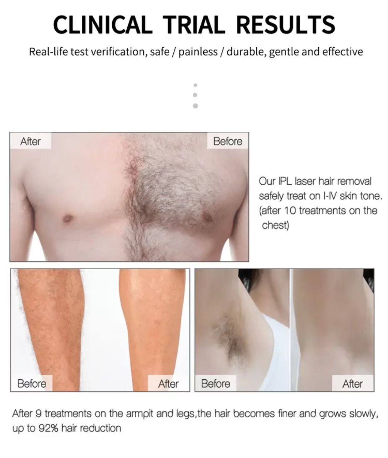 CLINICAL TRIAL RESULTS

Real-life test verification, safe / painless / durable, gentle and effective

Our IPL laser hair removal safely treat on I-IV skin tone. (after 10 treatments on the chest)

After 9 treatments on the armpit and legs, the hair becomes finer and grows slowly, up to 92% hair reduction