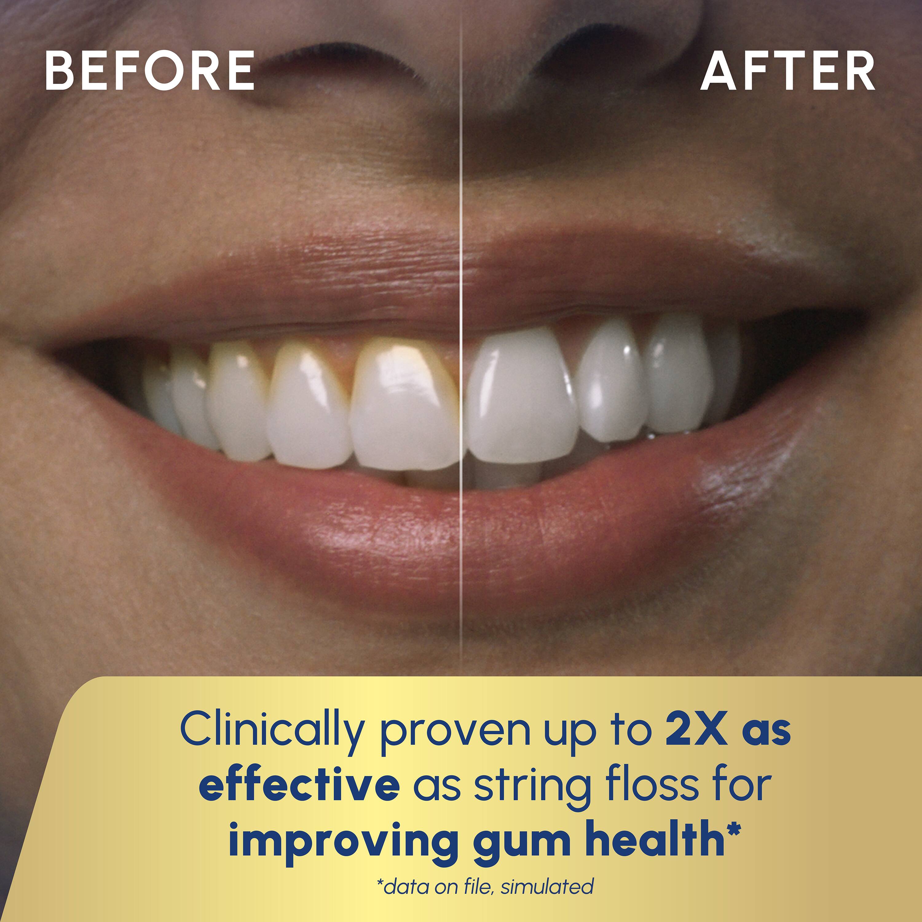 BEFORE AFTER

Clinically proven up to 2X as effective as string floss for improving gum health*

*data on file, simulated