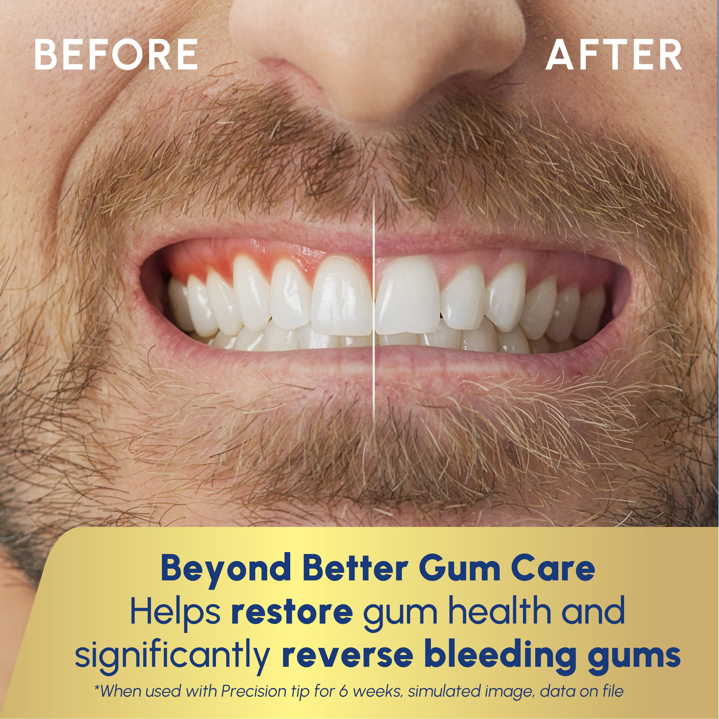 BEFORE AFTER

Beyond Better Gum Care  
Helps restore gum health and significantly reverse bleeding gums  
*When used with Precision tip for 6 weeks, simulated image, data on file