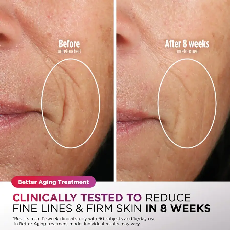 Before unretouched After 8 weeks unretouched Better Aging Treatment CLINICALLY TESTED TO REDUCE FINE LINES & FIRM SKIN IN 8 WEEKS *Results from a 12-week clinical study with 60 subjects and 1x/day use in the Better Aging treatment mode. Individual results may vary.