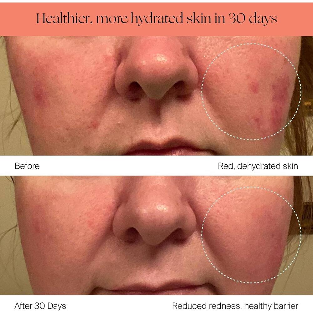 Healthier, more hydrated skin in 30 days

Before  
Red, dehydrated skin

After 30 Days  
Reduced redness, healthy barrier
