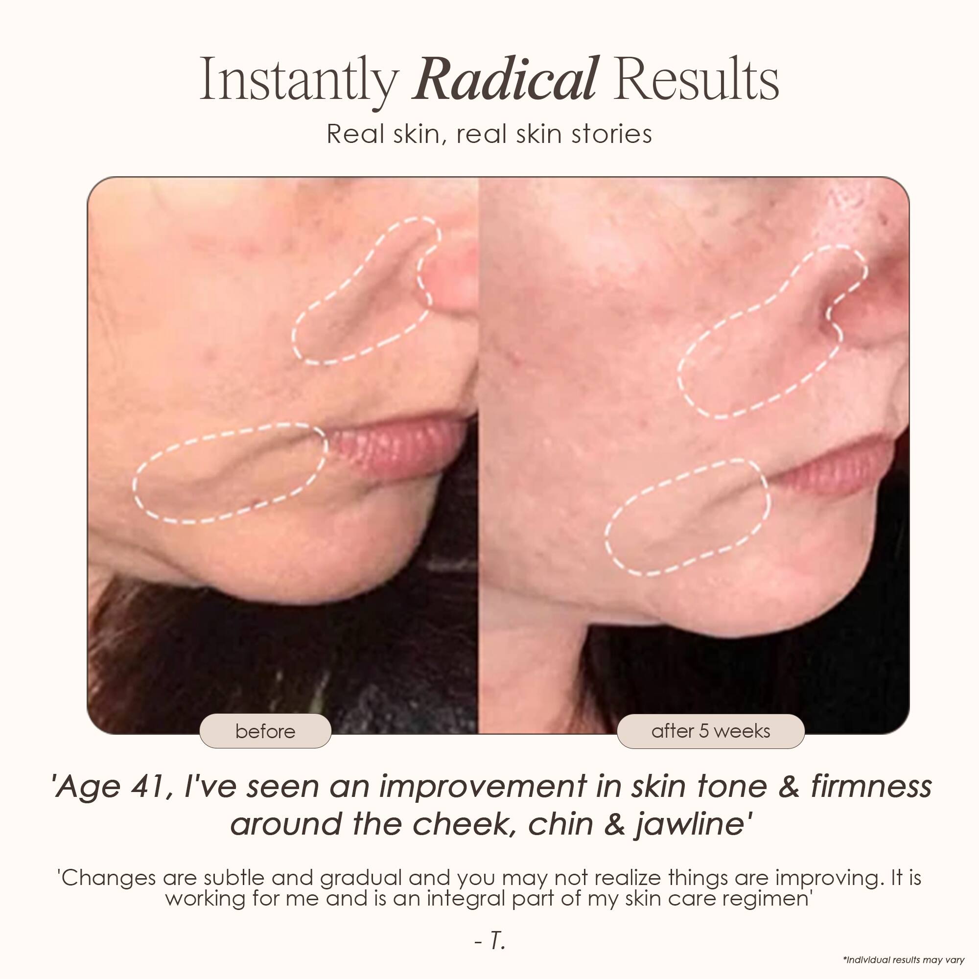Instantly Radical Results  
Real skin, real skin stories  

before  
after 5 weeks  

'Age 41, I've seen an improvement in skin tone & firmness around the cheek, chin & jawline'  

'Changes are subtle and gradual and you may not realize things are improving. It is working for me and is an integral part of my skin care regimen' - T.  

*Individual results may vary