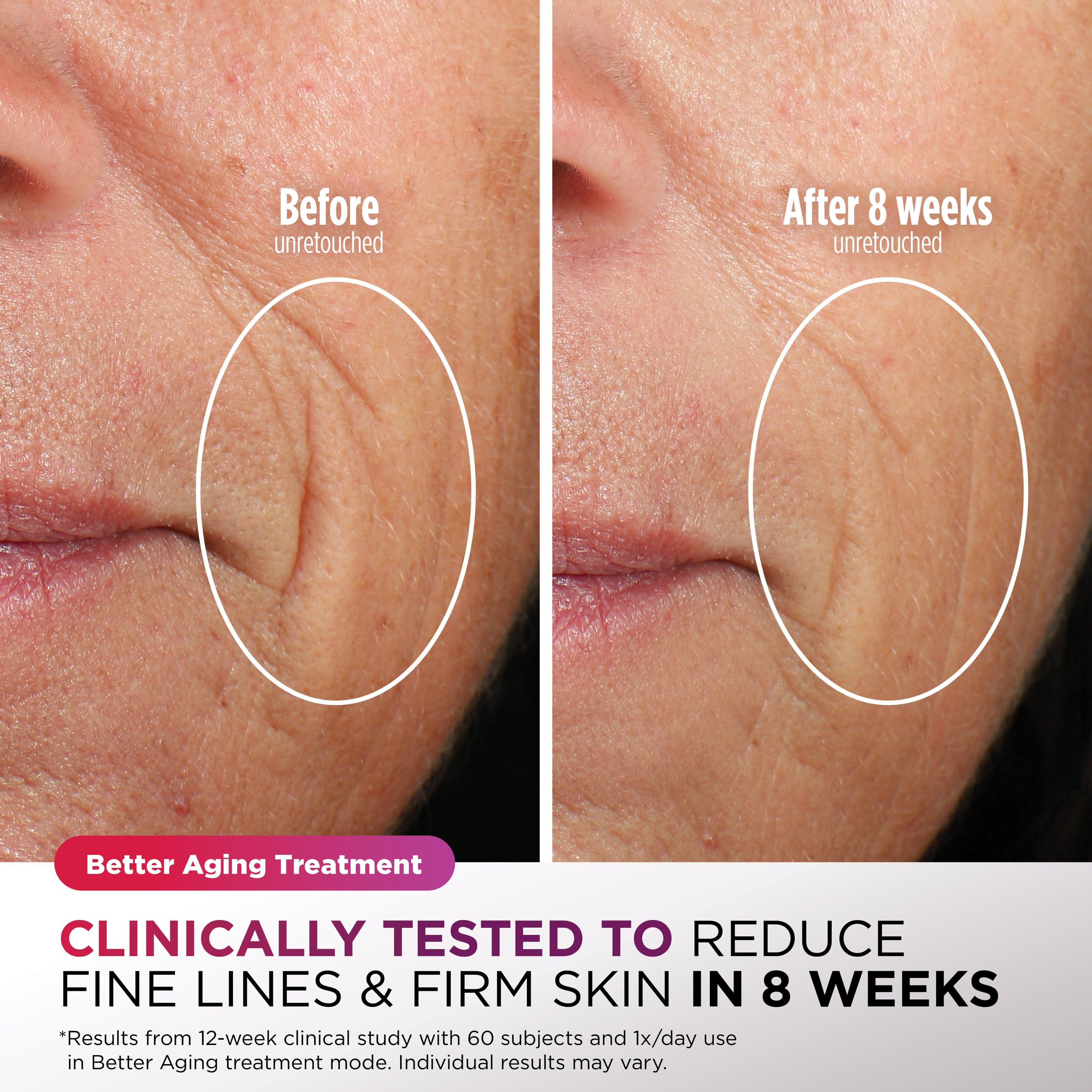 Before unretouched, After 8 weeks unretouched. Better Aging Treatment. Clinically tested to reduce fine lines & firm skin in 8 weeks. *Results from a 12-week clinical study with 60 subjects and 1x/day use in Better Aging treatment mode. Individual results may vary.