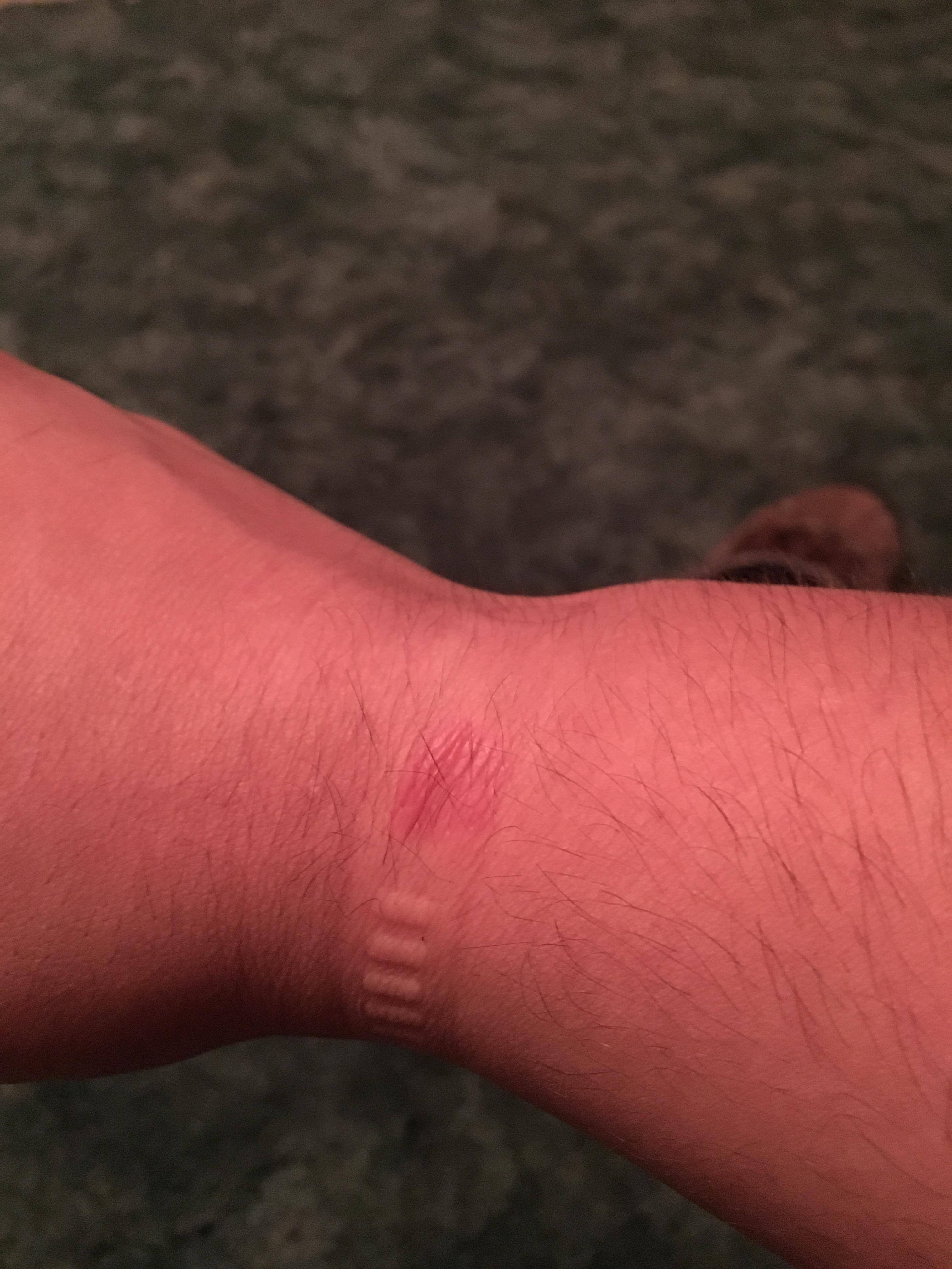 Right side of wrist, click to load a larger version