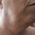 Uncut stubble on right neck after 3 day growth., click to load a larger version