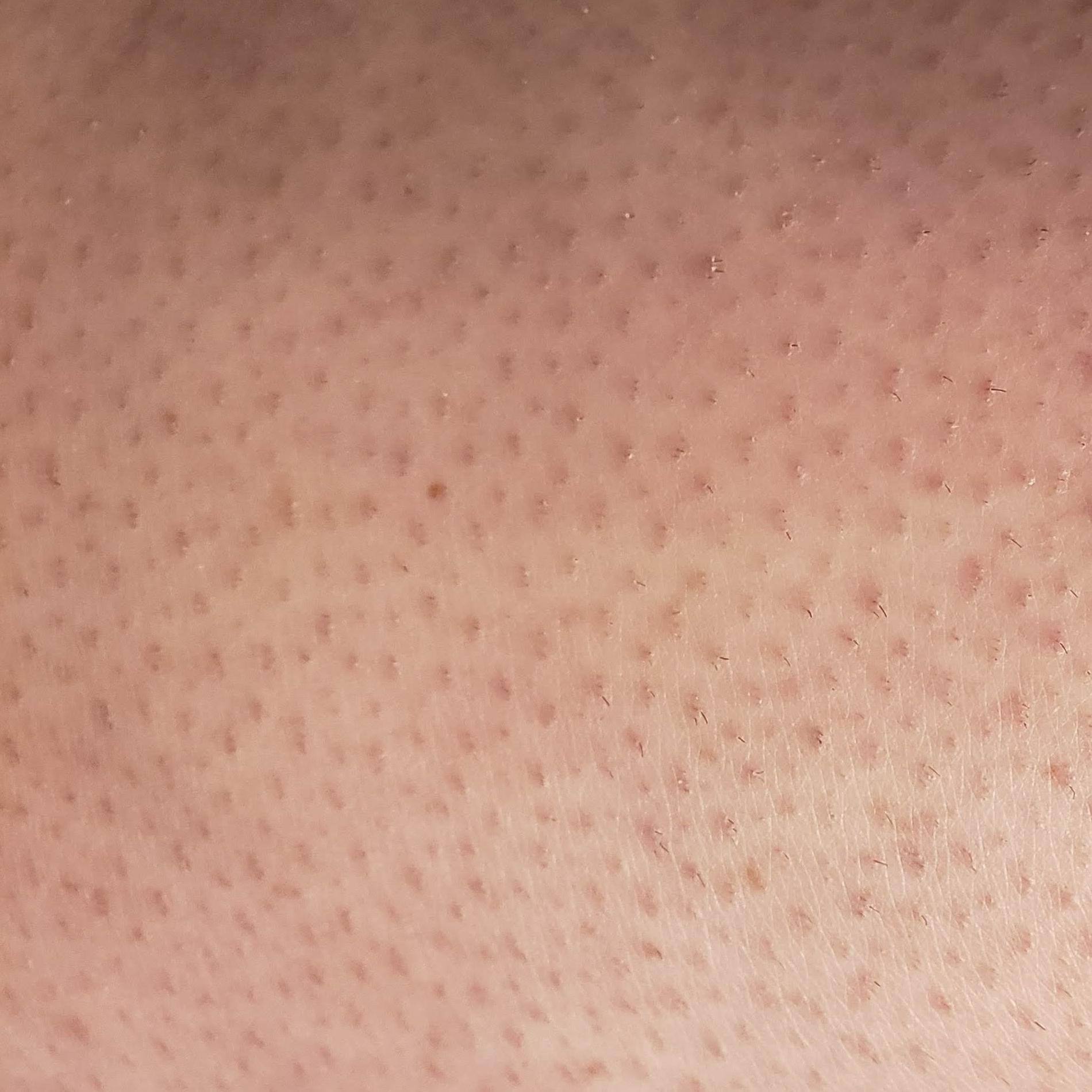 Just before first treament 24 hours after shave, click to load a larger version