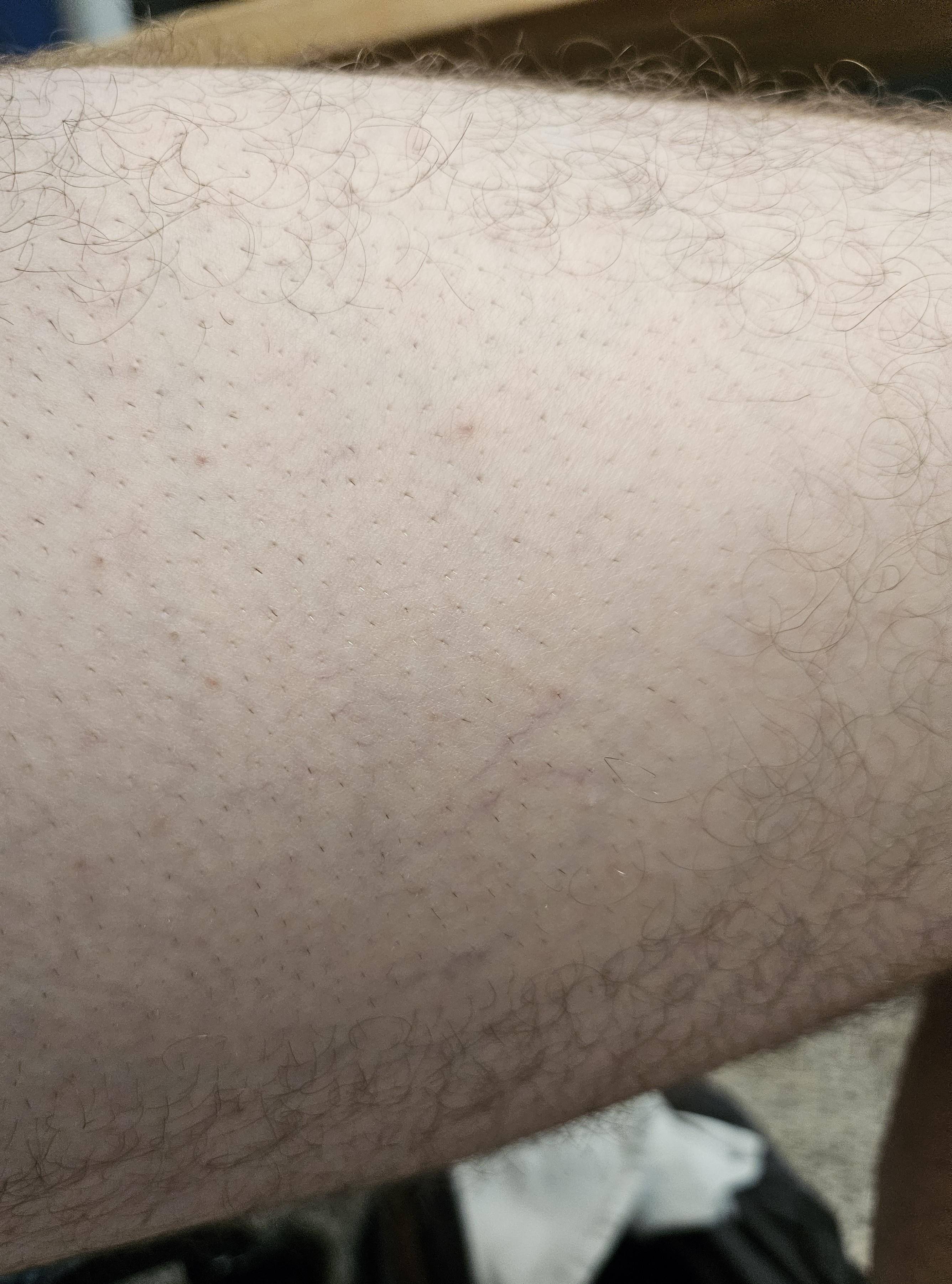 I did the Skin Test on the side of my thigh as it would be the least inconvenient part of my body if it was to be burned.  Luckily, it was not an issue, though I could barely tell immediately after the test if there were any results., click to load a larger version