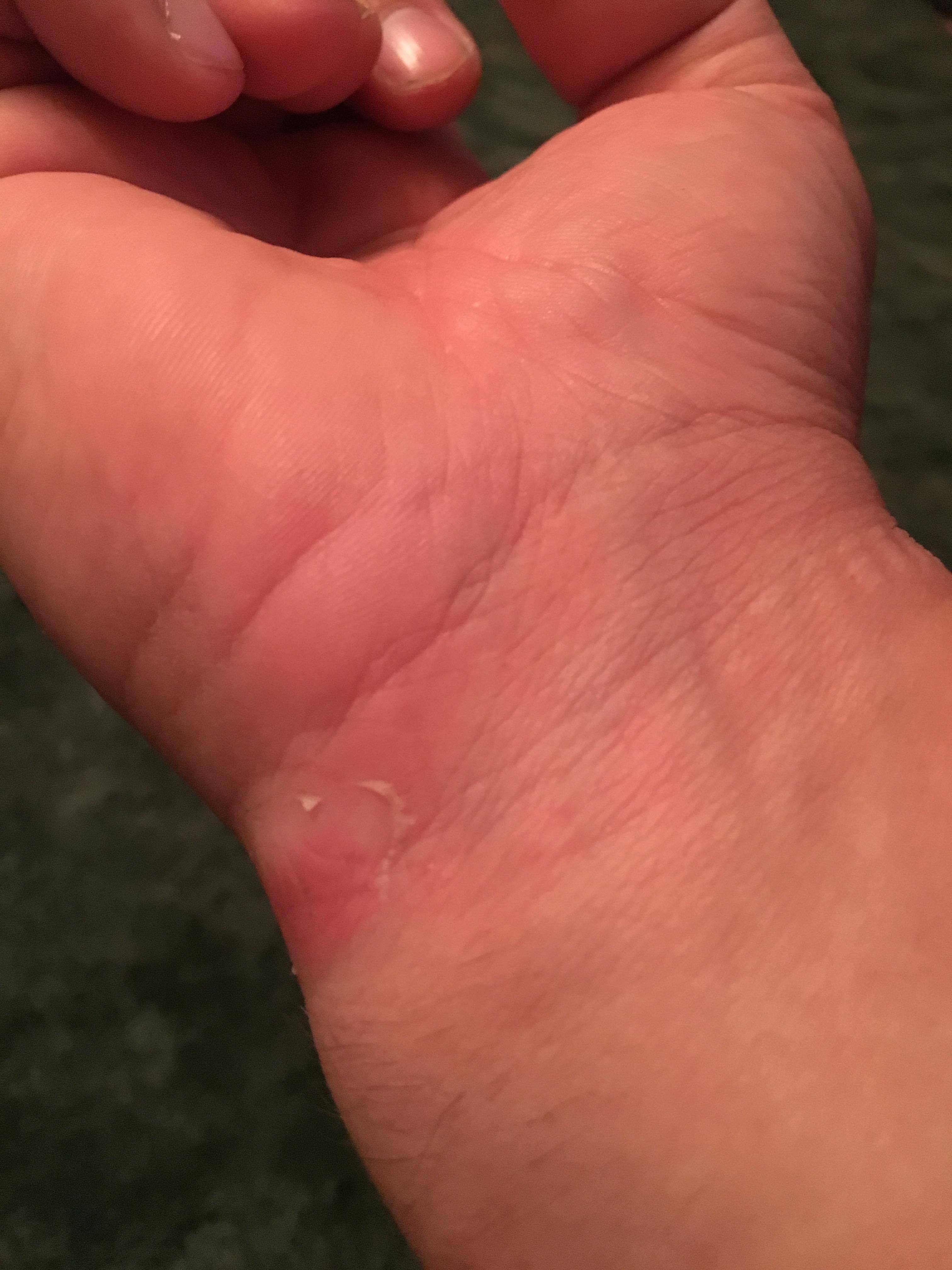 Left side of wrist, click to load a larger version