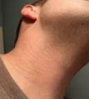 Heavy treatment towards the t-shirt line, lighter above (Red and blue = heavy, blue only = 3-4 passes )  - ingrown hair spots almost totally healed ! WOW !, click to load a larger version