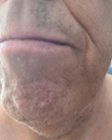 Uncut stubble on upper left mustache and left neck after 3 day growth., click to load a larger version