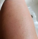 Post use redness that faded about 3 hours later., click to load a larger version