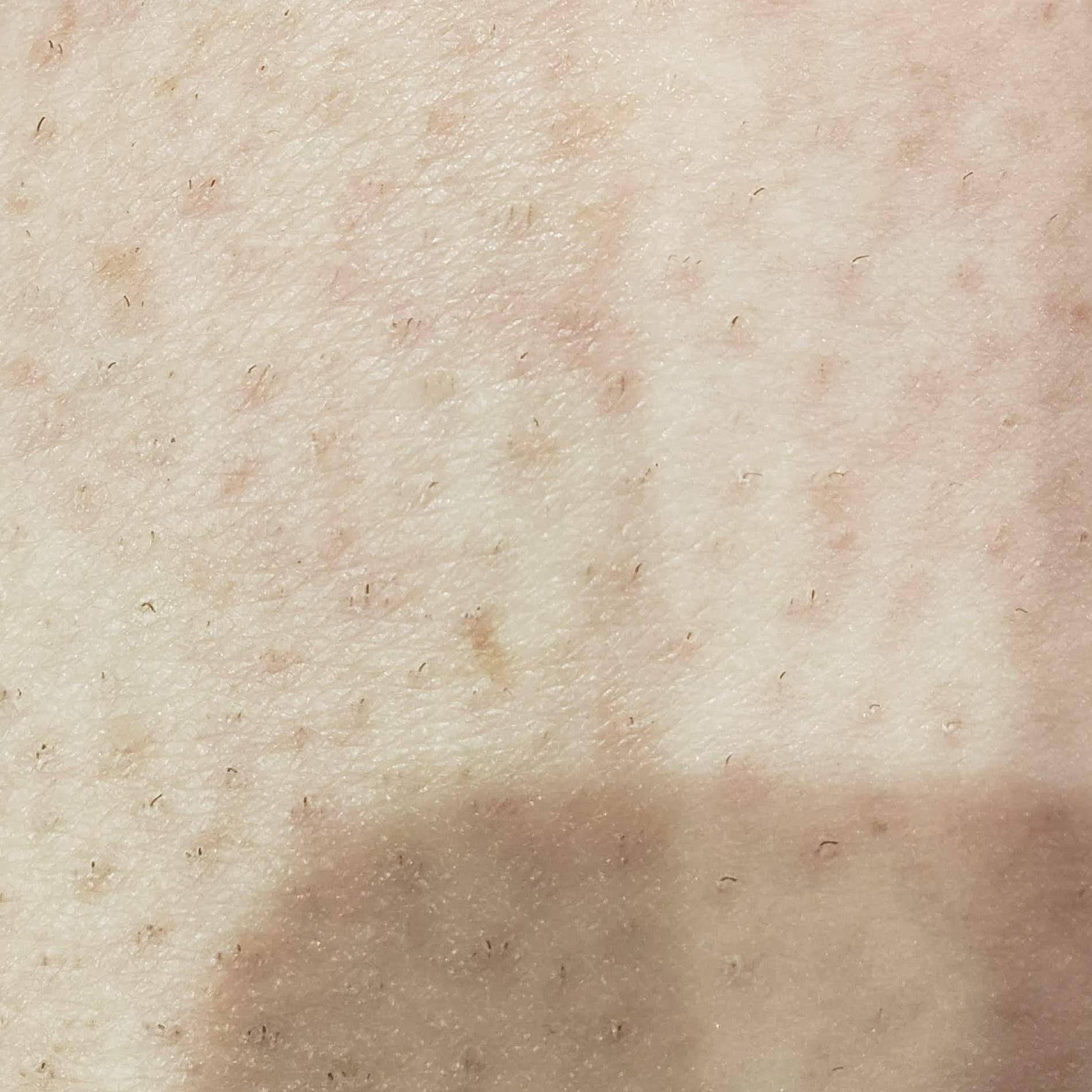 Nearly 4 months of treament and 24 hours after shave. Hair growth is reduced but enough still grow to need regular shaving, click to load a larger version