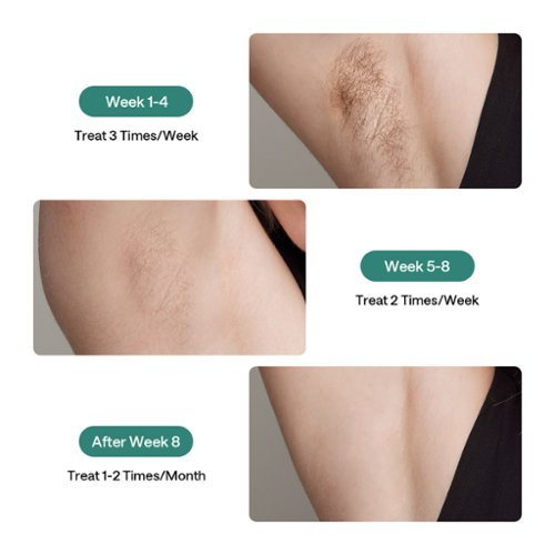 Ulike Air 2 Ice Cooling IPL Dry Hair Removal Device - Dark Green WHERE TO BUY