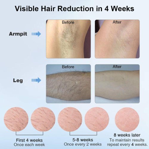 MLAY T4 IPL Laser Hair Removal for Women/Men, 15.5J Energy, Ice-Cooling Painless Tech, Effective & Long-Lasting from Home - Rose Gold SHOP ONLINE
